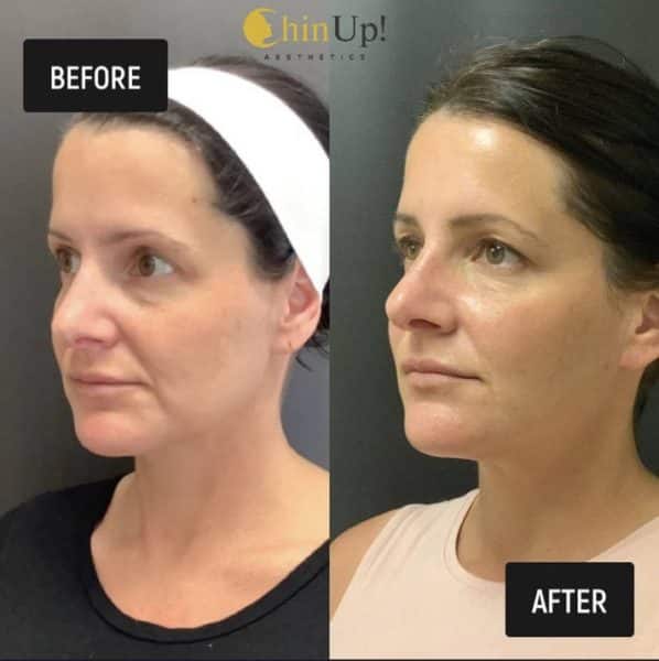Sculptra Aesthetics
