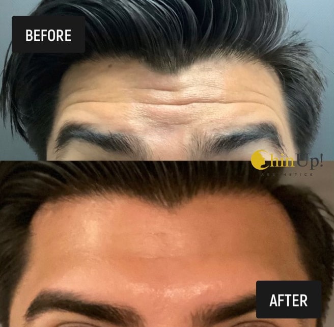 Wrinkle reduction treatment before and after image