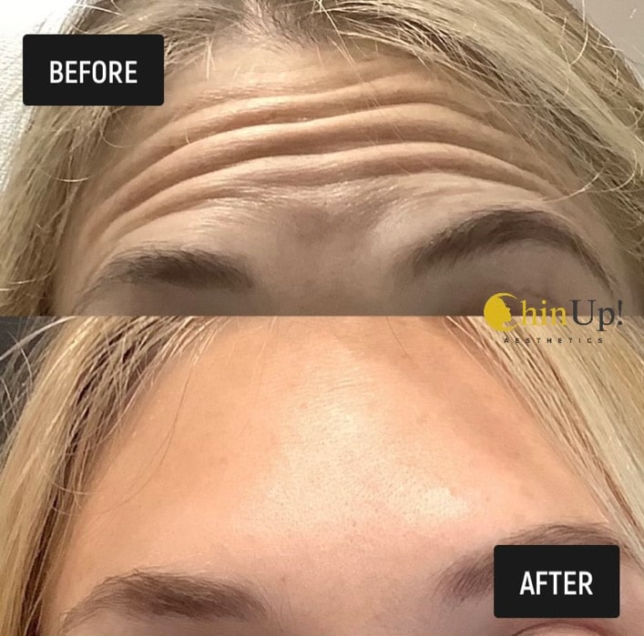 Wrinkle reduction treatment before and after image