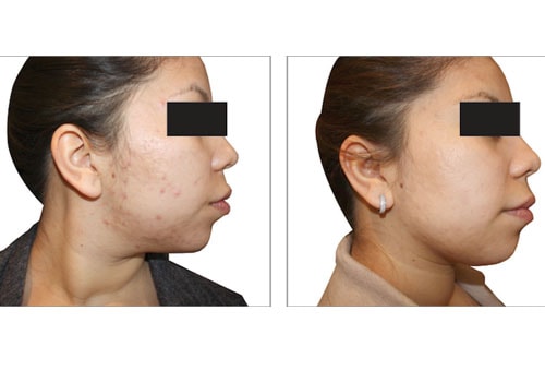 Acne Reduction treatment