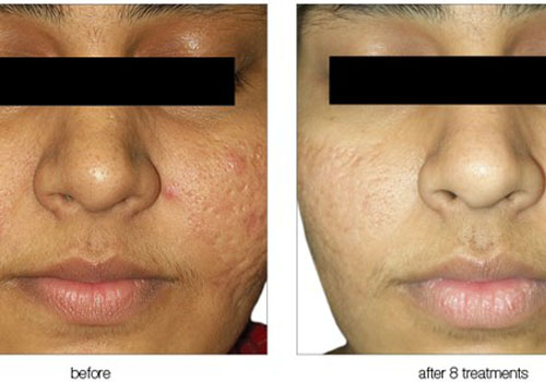 Acne reduction treatment