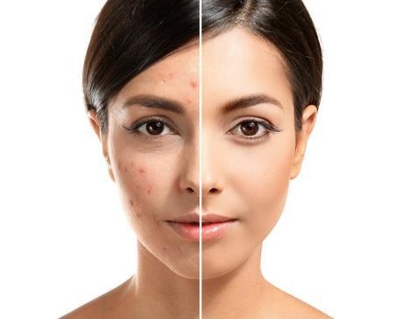 Before and After photo of Venus Versa Acne Treatment