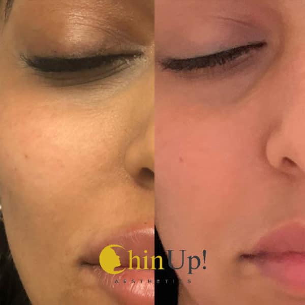 MicroNeedling Offer Chin Up Aesthetics