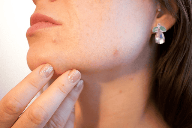 spot treatments for acne