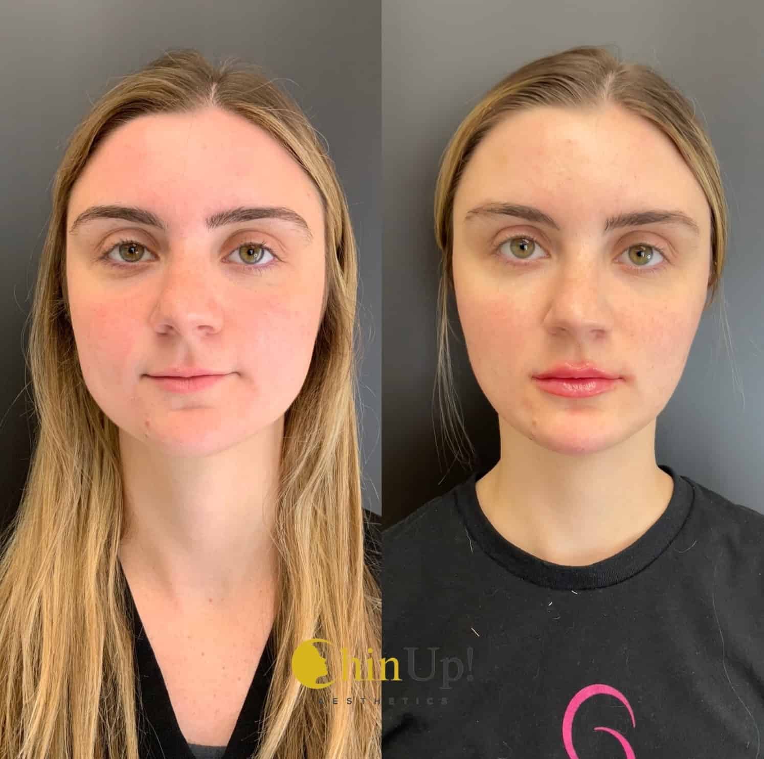 Dramatic Results for lower eyelid