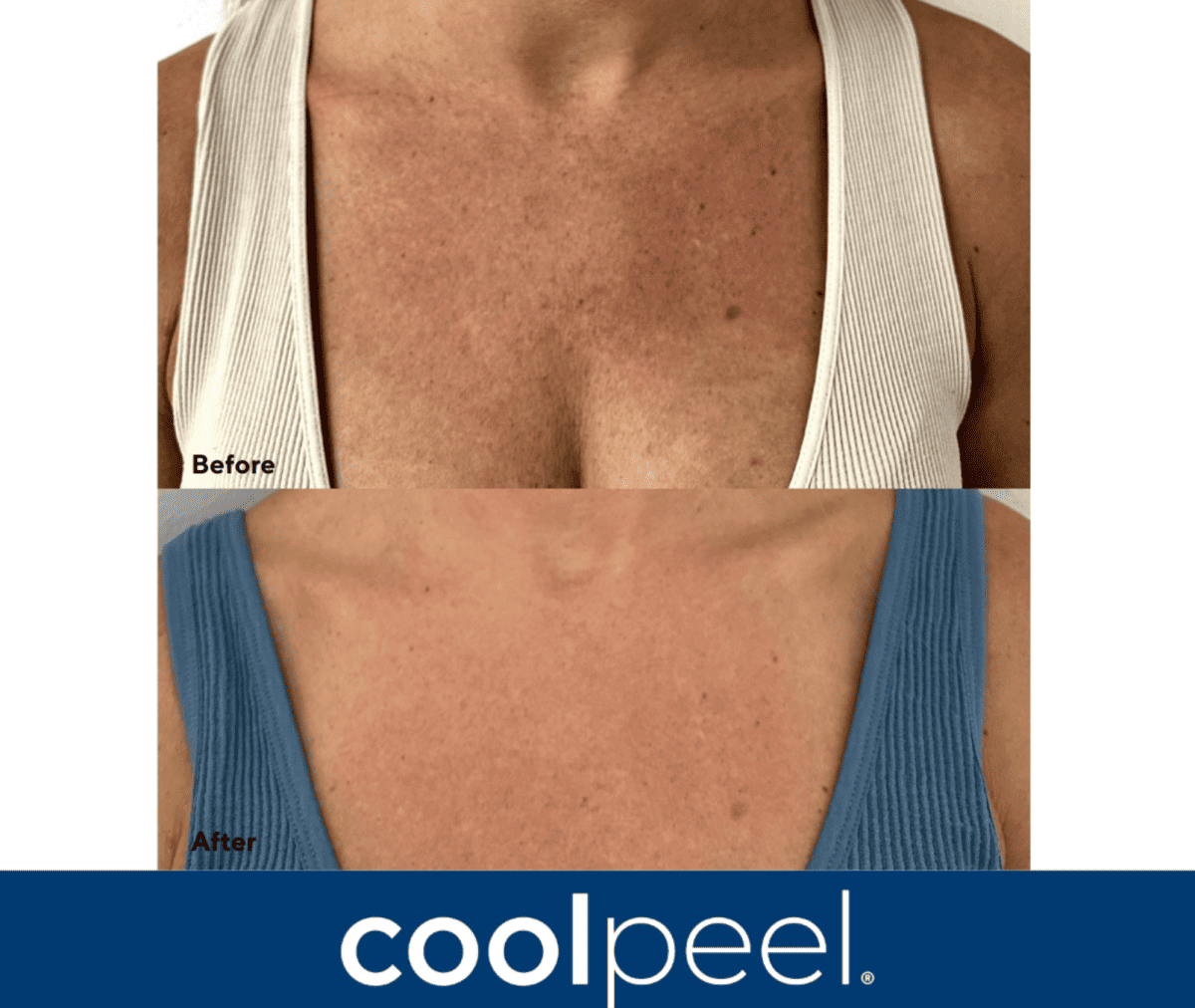 Ultimate duo treatment,CoolPeel and RF microneedling combo,skin resurfacing Atlanta,RF microneedling with laser,best treatment for texture and wrinkles,CoolPeel vs RF microneedling,non-surgical skin tightening,collagen boost facial Atlanta