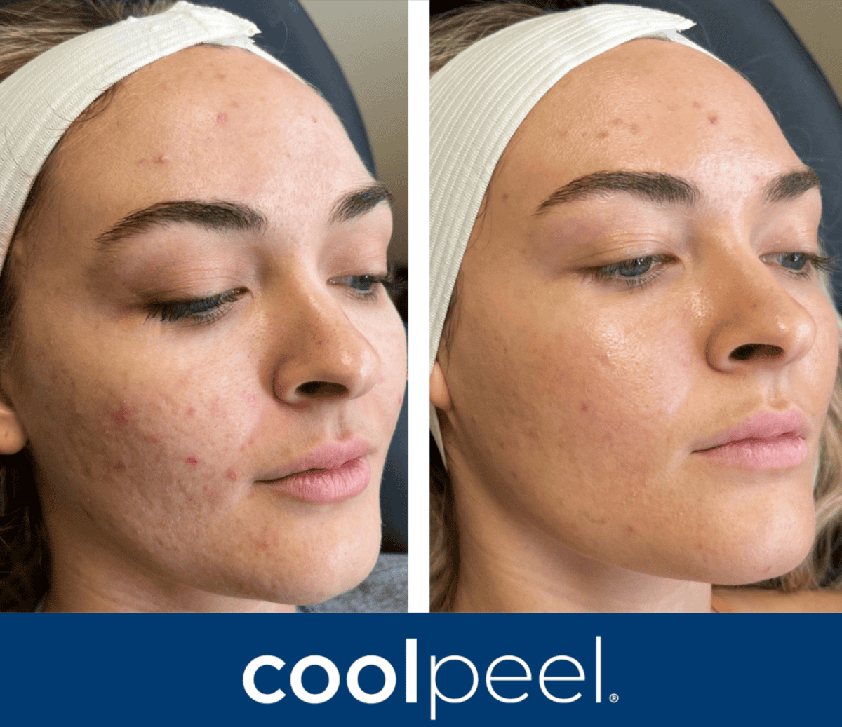 Ultimate duo treatment,CoolPeel and RF microneedling combo,skin resurfacing Atlanta,RF microneedling with laser,best treatment for texture and wrinkles,CoolPeel vs RF microneedling,non-surgical skin tightening,collagen boost facial Atlanta