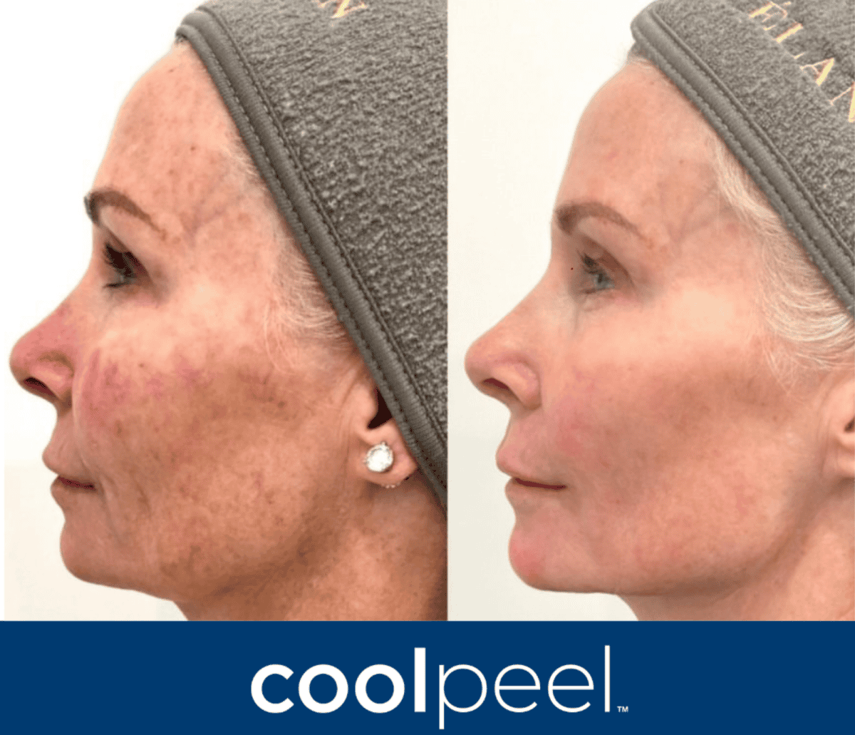 Ultimate duo treatment,CoolPeel and RF microneedling combo,skin resurfacing Atlanta,RF microneedling with laser,best treatment for texture and wrinkles,CoolPeel vs RF microneedling,non-surgical skin tightening,collagen boost facial Atlanta