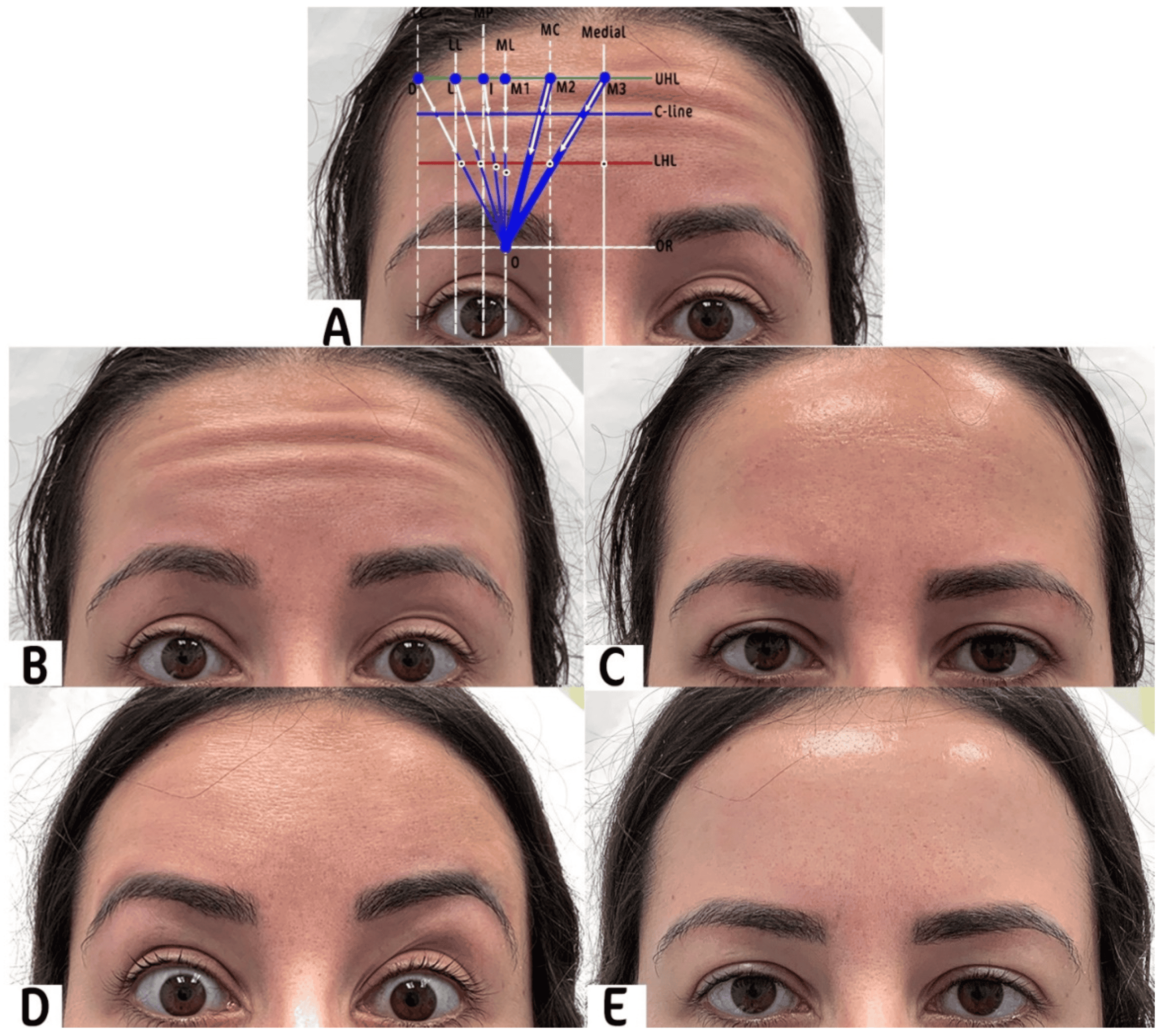 Forehead Botox