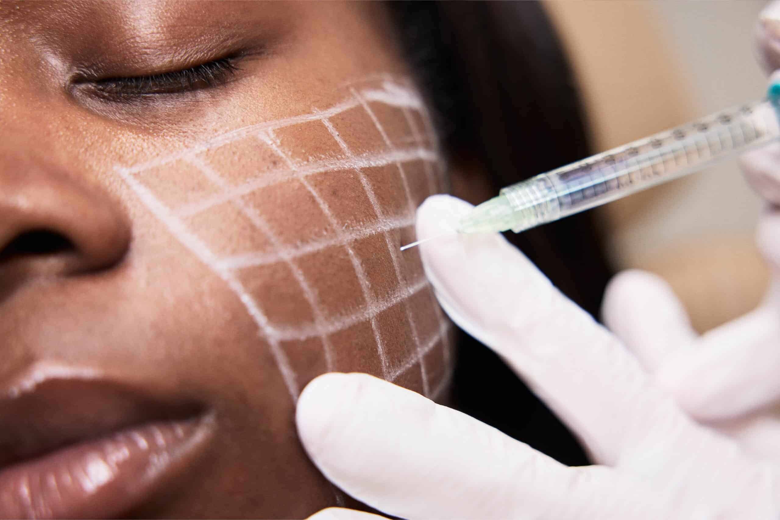 Grid-marked skin with syringe for cosmetic treatment.