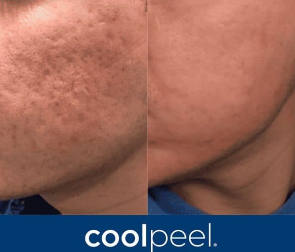 close up side by side comparison of a person's cheek before and after treatment; the left side shows acne scars and uneven texture, while the right side appears smoother and clearer. &quot;coolpeel&quot; is written at the bottom. medspa near me