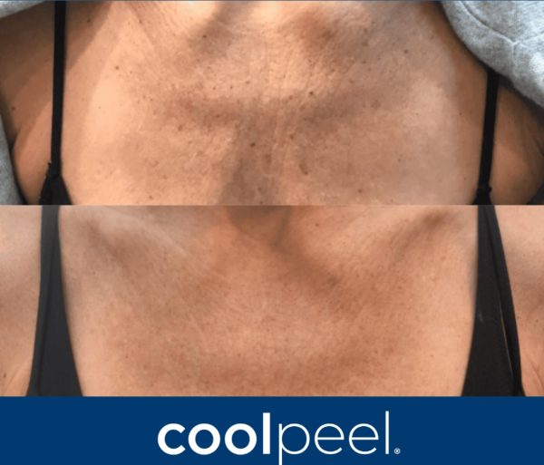before and after photos of a person’s chest area showing visible skin texture improvement, with the &quot;coolpeel&quot; logo at the bottom. the top image shows rougher skin; the bottom image shows smoother, clearer skin. medspa near me