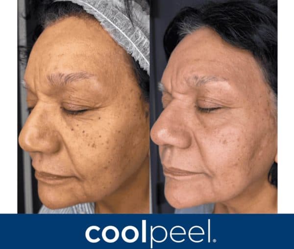 side by side photos of a woman’s face before and after a coolpeel treatment, showing reduced dark spots and smoother skin texture; logo “coolpeel” is displayed at the bottom. medspa near me