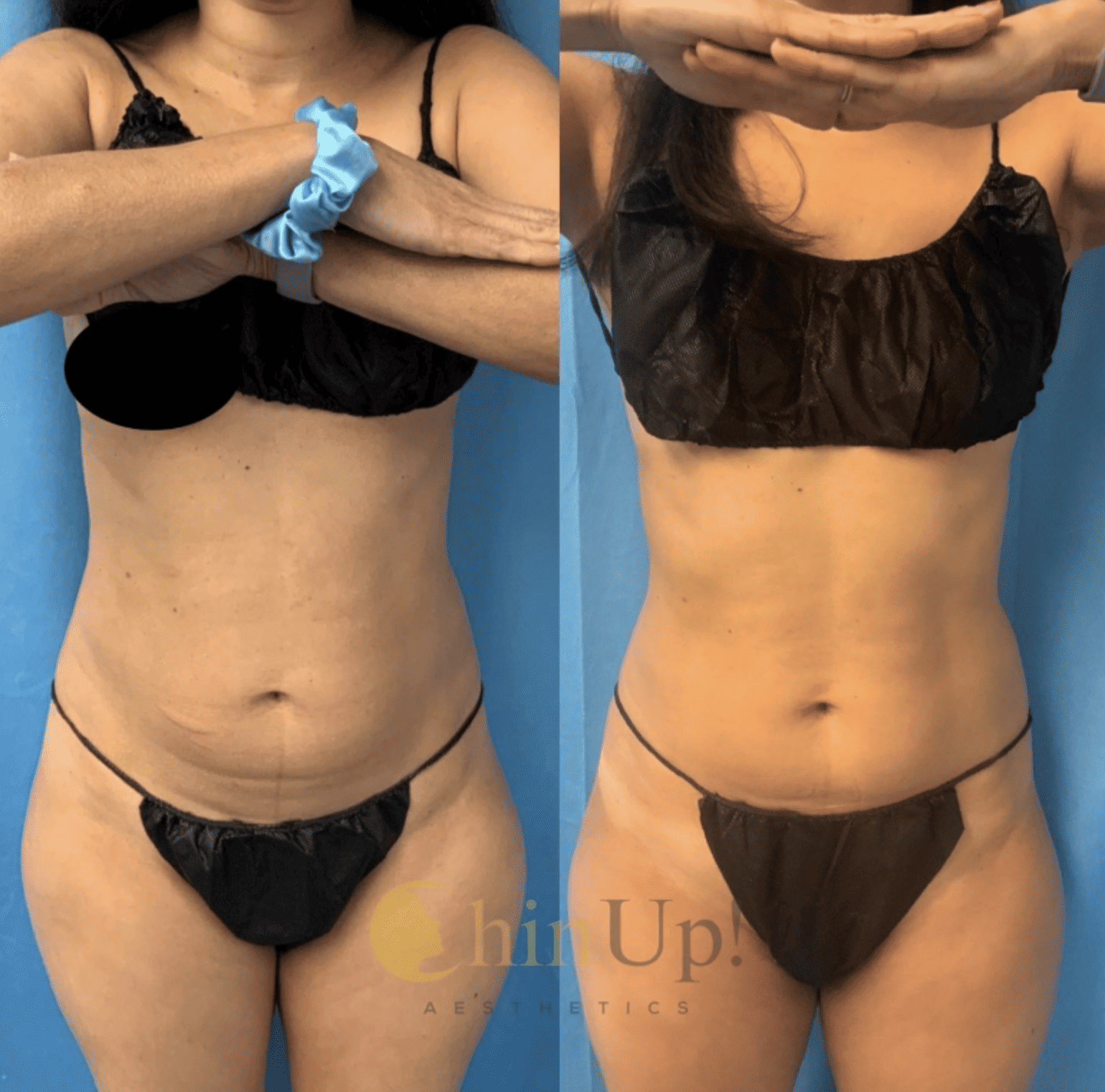 Before and after body contouring results.
