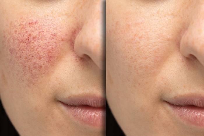 Before and after skincare treatment on face.