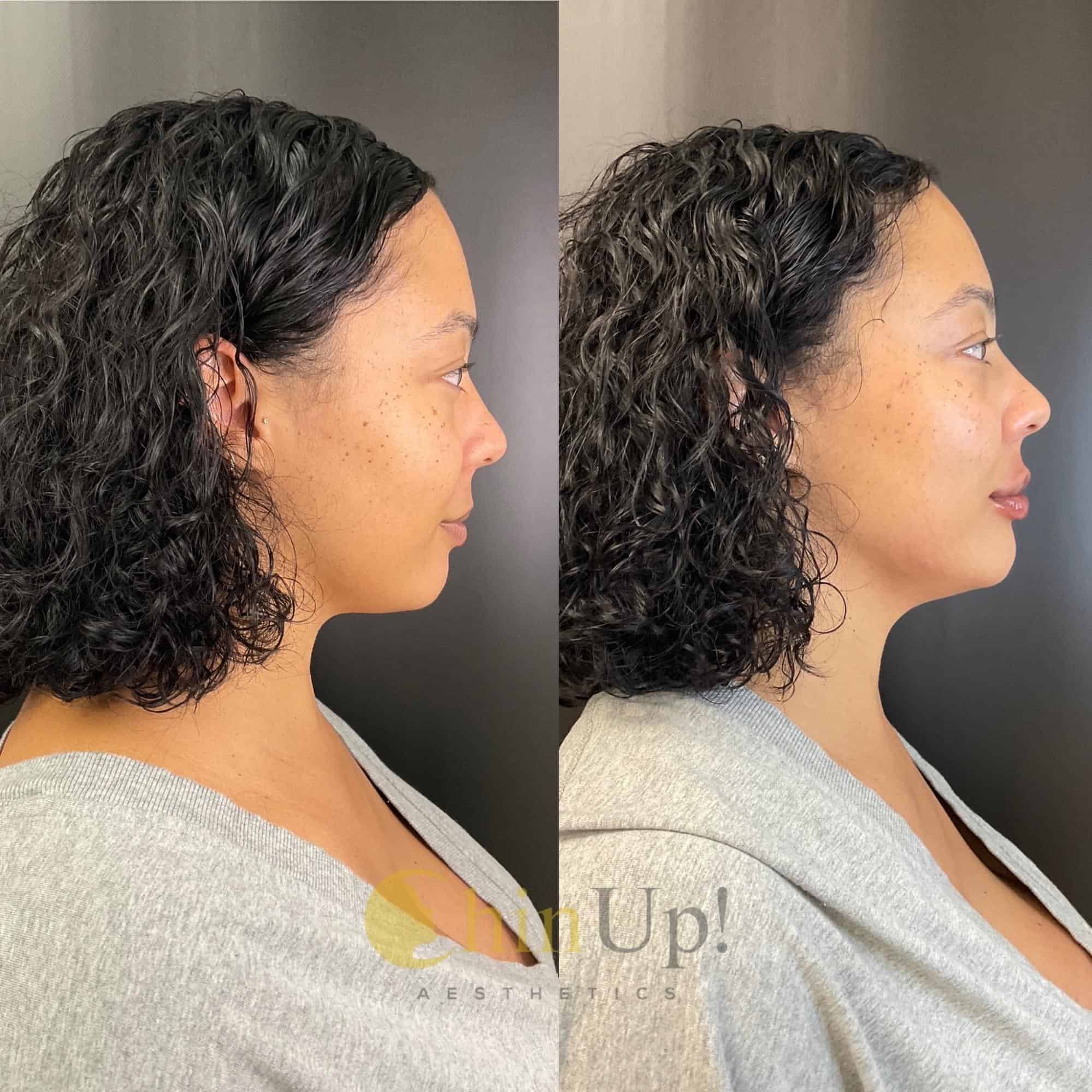Side profile before and after photos showing improved chin projection and jawline definition