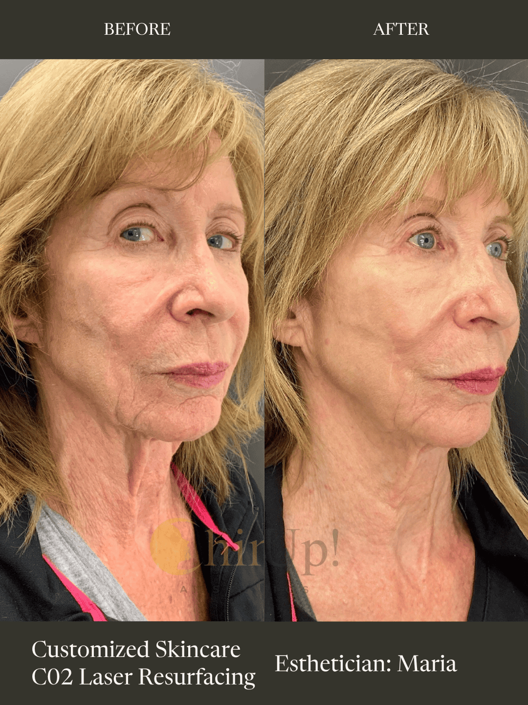 Front-facing before and after photos showing smoother skin texture and tone after one CoolPeel CO2 laser treatment