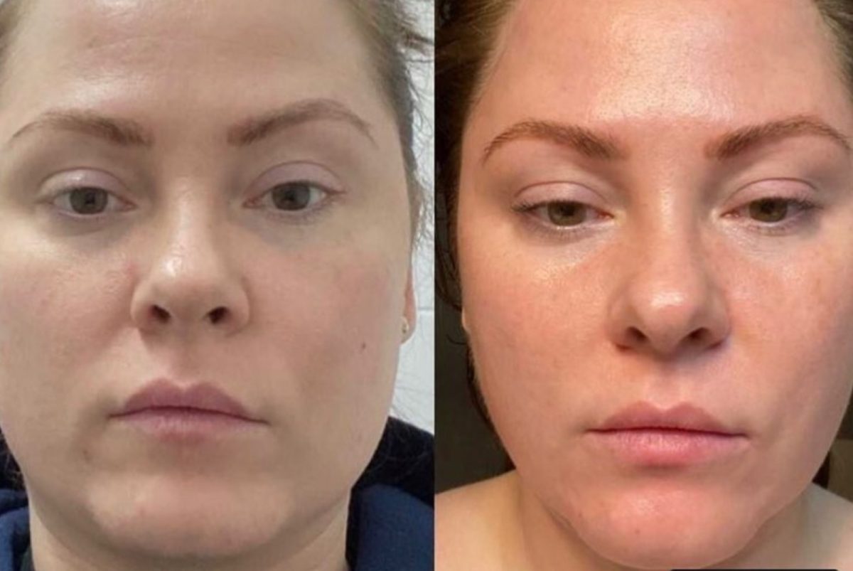 Botox & Dysport: before and after, Botox & Dysport at Chin Up Aesthetics