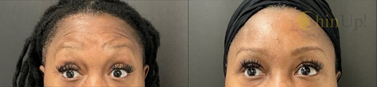 Dysport: before and after, Botox & Dysport at Chin Up Aesthetics