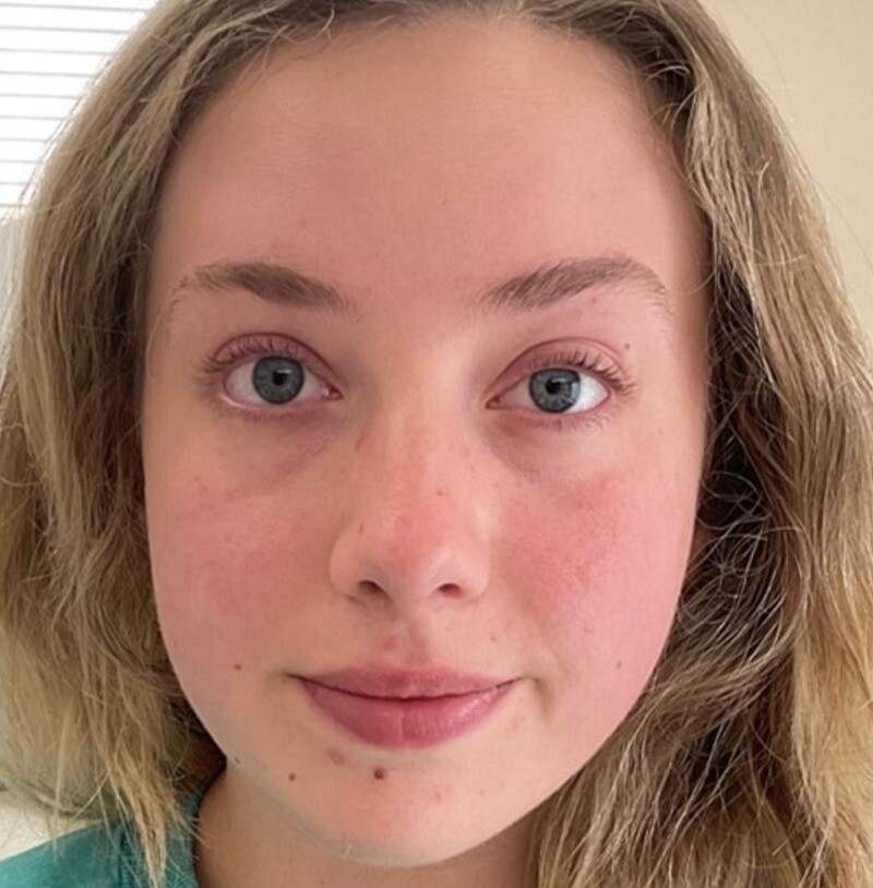 Dysport to address forehead lines: after at Chin Up Aesthetics