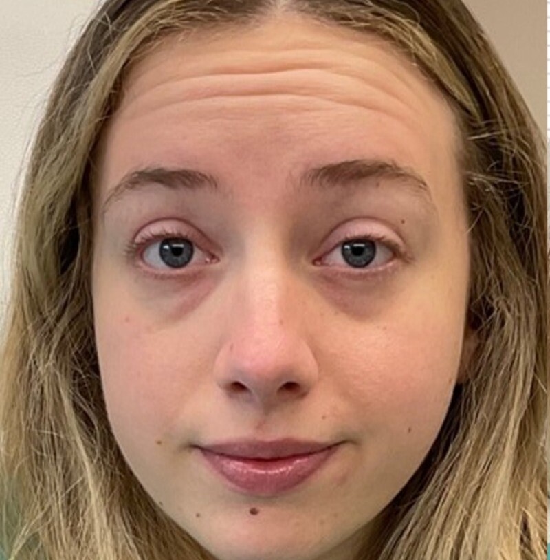 Dysport to address forehead lines: before at Chin Up Aesthetics