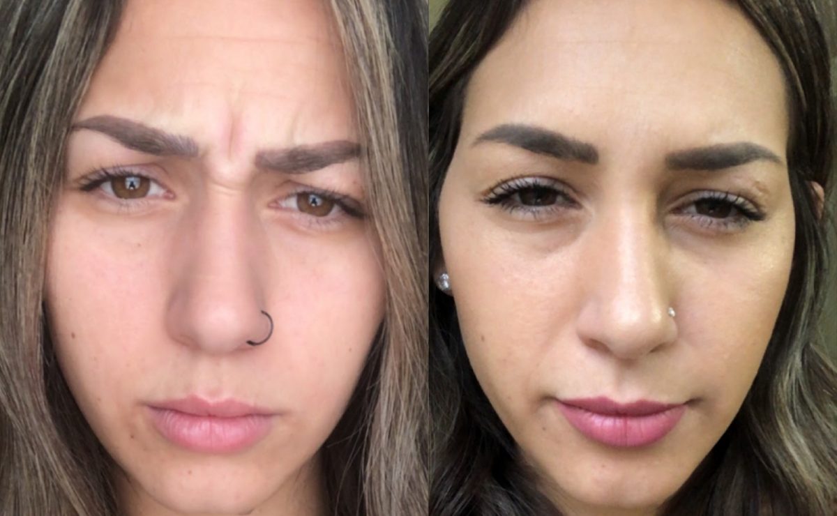 Dysport to address frown line: before and after, Botox & Dysport at Chin Up Aesthetics