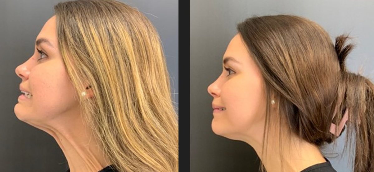 Platysmal Bands: before and after, Botox & Dysport at Chin Up Aesthetics