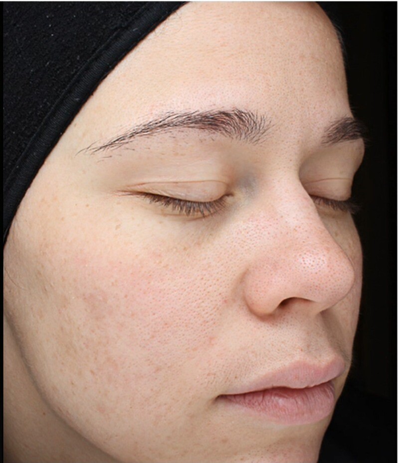 Cool Peel (CO2): after at Chin Up Aesthetics