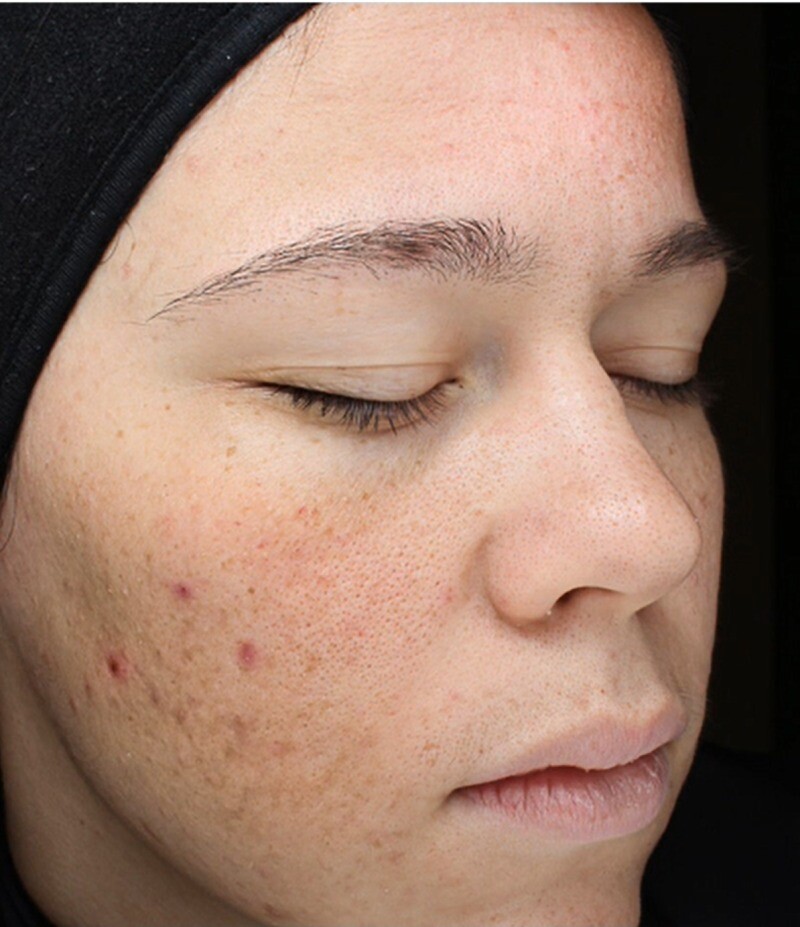 Cool Peel (CO2): before at Chin Up Aesthetics