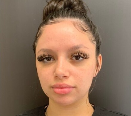 Microneedling, Chemical Peel, & Skinbetter: after at Chin Up Aesthetics