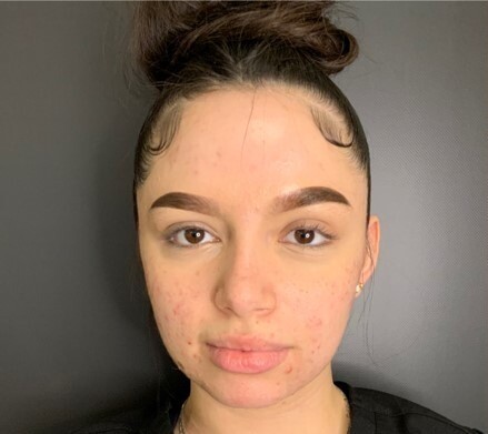Microneedling, Chemical Peel, & Skinbetter: before at Chin Up Aesthetics