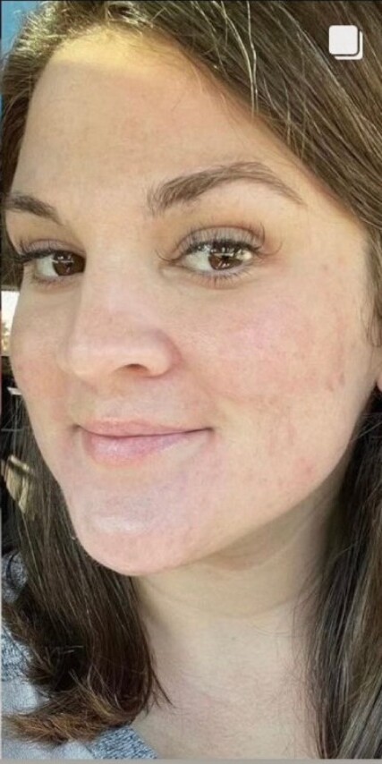 RF Microneedling and Chemical Peel: after at Chin Up Aesthetics