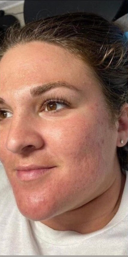 RF Microneedling and Chemical Peel: before at Chin Up Aesthetics