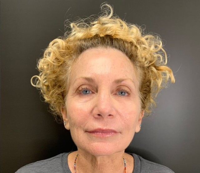 RF Microneedling and Cool Peel (CO2): after at Chin Up Aesthetics