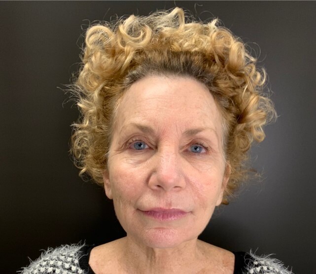 RF Microneedling and Cool Peel (CO2): before at Chin Up Aesthetics