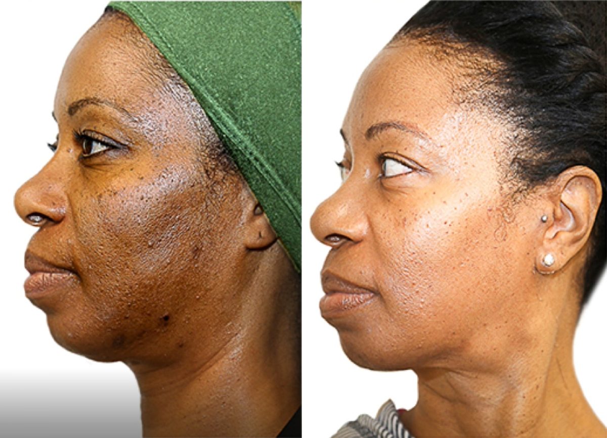 VI Chemical Peel: before and after, Chemical Peel at Chin Up Aesthetics
