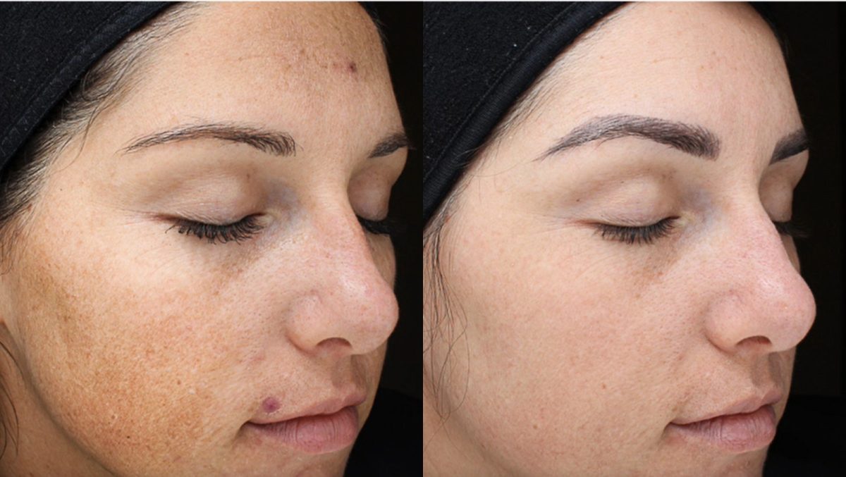 Cool Peel (CO2): before and after, CO2 Laser at Chin Up Aesthetics