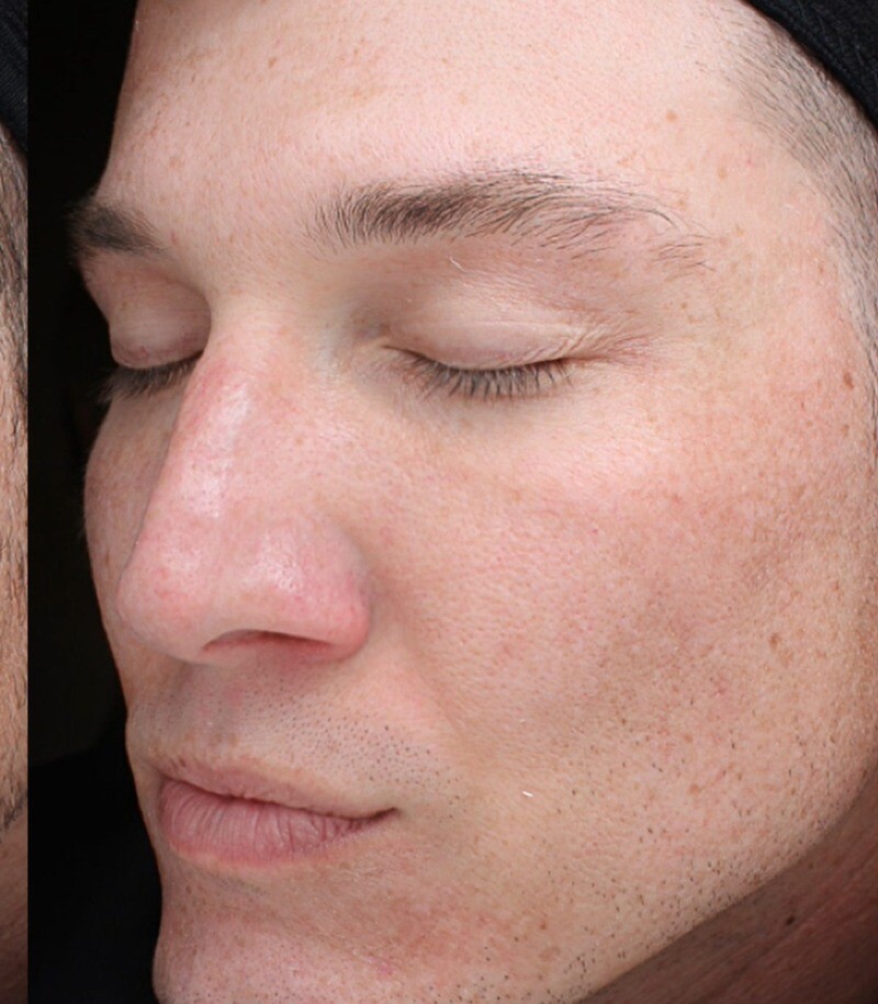 Cool Peel (CO2): after at Chin Up Aesthetics