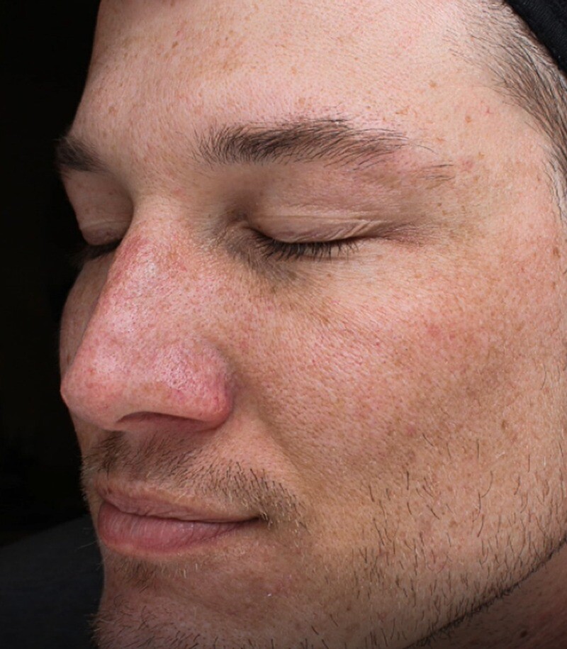 Cool Peel (CO2): before at Chin Up Aesthetics
