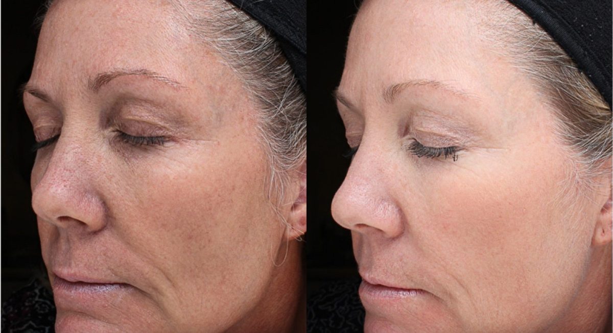 Cool Peel (CO2): before and after, CO2 Laser at Chin Up Aesthetics