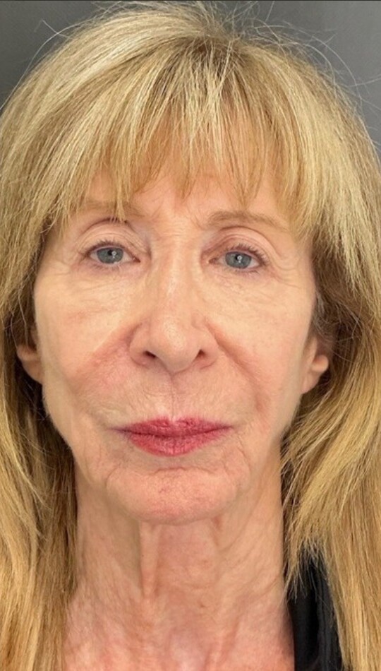 Customized Skincare & CO2 Laser Resurfacing: after at Chin Up Aesthetics