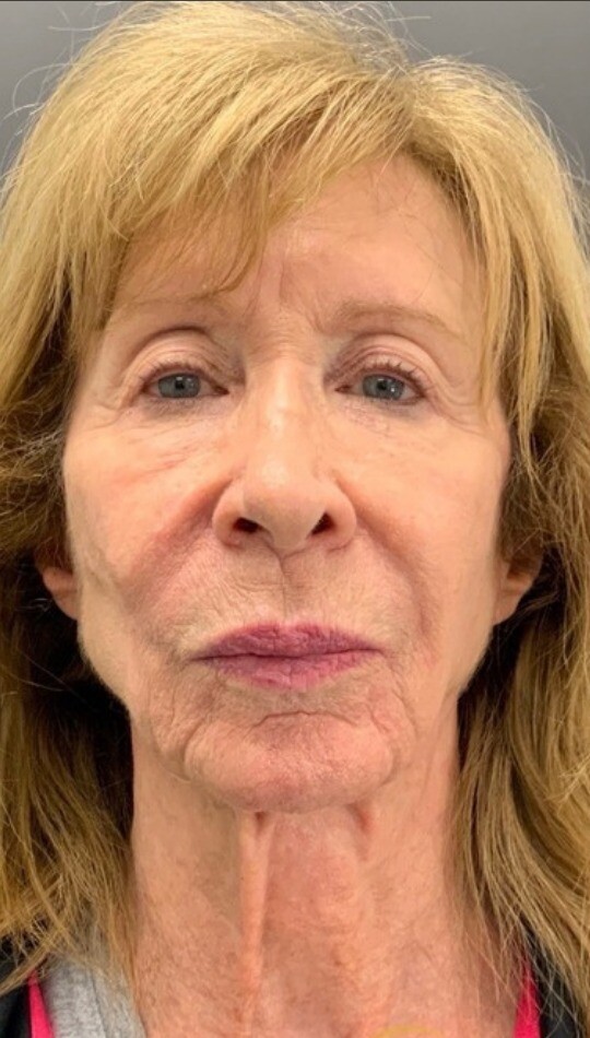 Customized Skincare & CO2 Laser Resurfacing: before at Chin Up Aesthetics