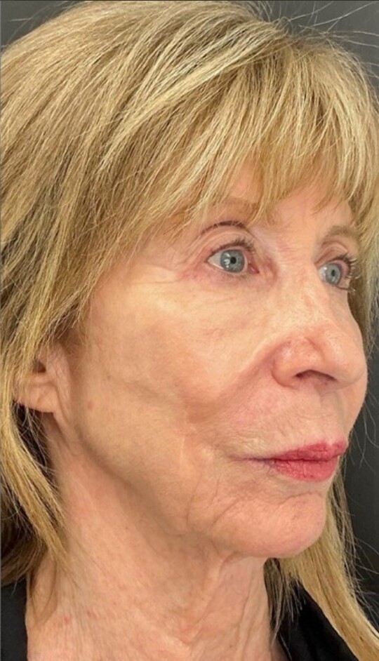 Customized Skincare & CO2 Laser Resurfacing: after at Chin Up Aesthetics