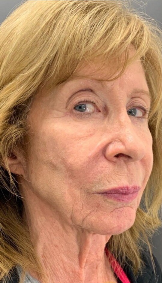 Customized Skincare & CO2 Laser Resurfacing: before at Chin Up Aesthetics