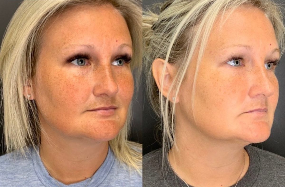 Dermal Filler: before and after, Dermal Filler at Chin Up Aesthetics
