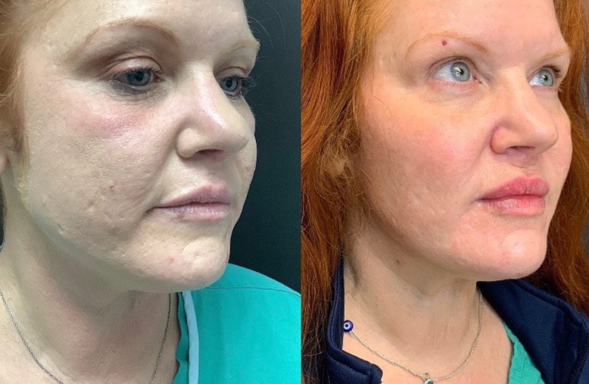 Facial Balancing: before and after, Dermal Filler at Chin Up Aesthetics