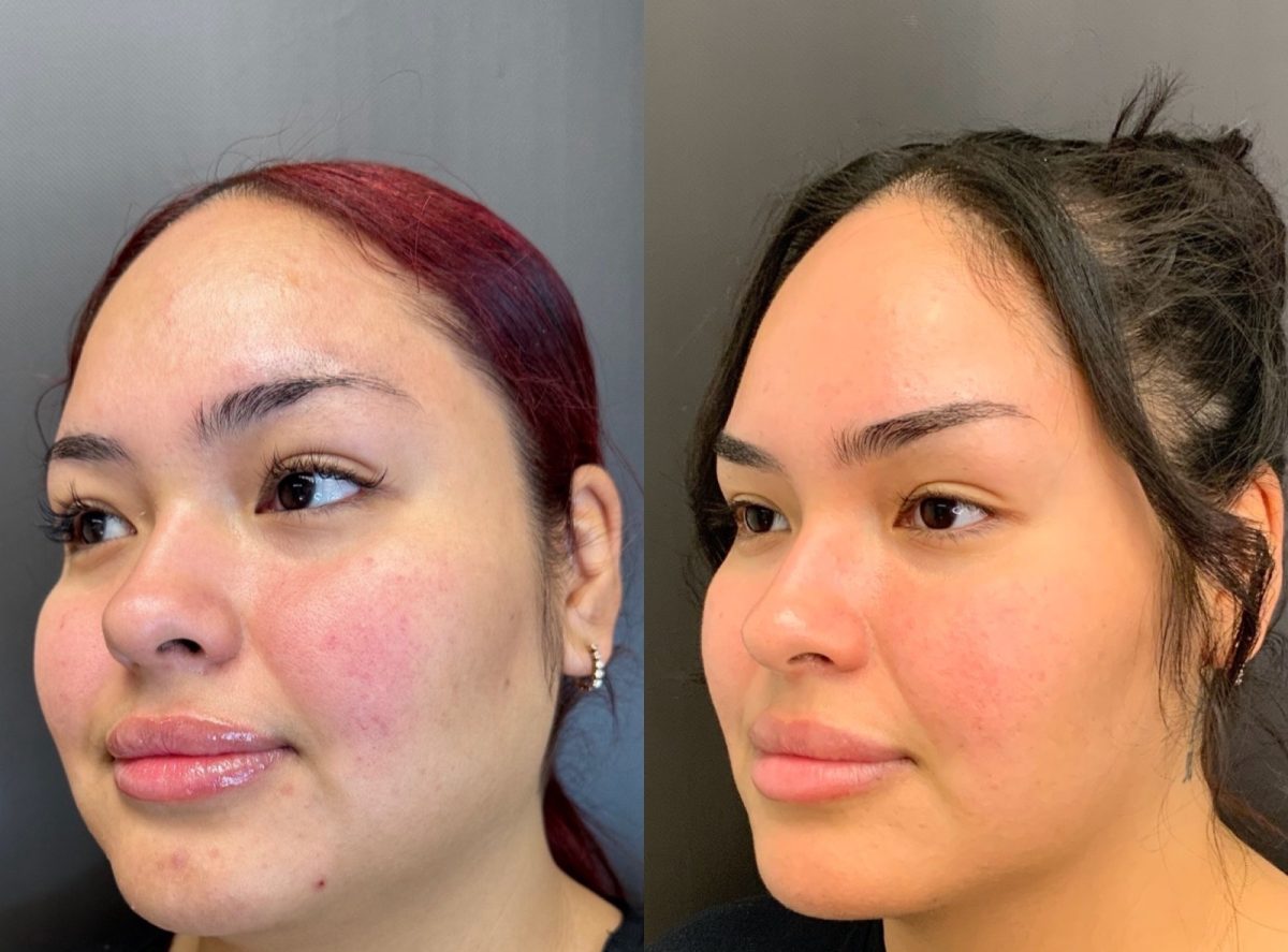 Facial Balancing & Medical Grade Skincare: before and after, Dermal Filler at Chin Up Aesthetics