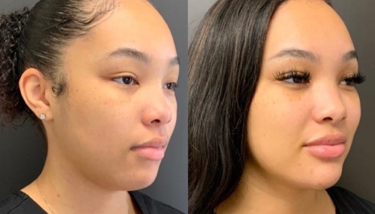 Kybella & Chin Filler: before and after, Dermal Filler at Chin Up Aesthetics