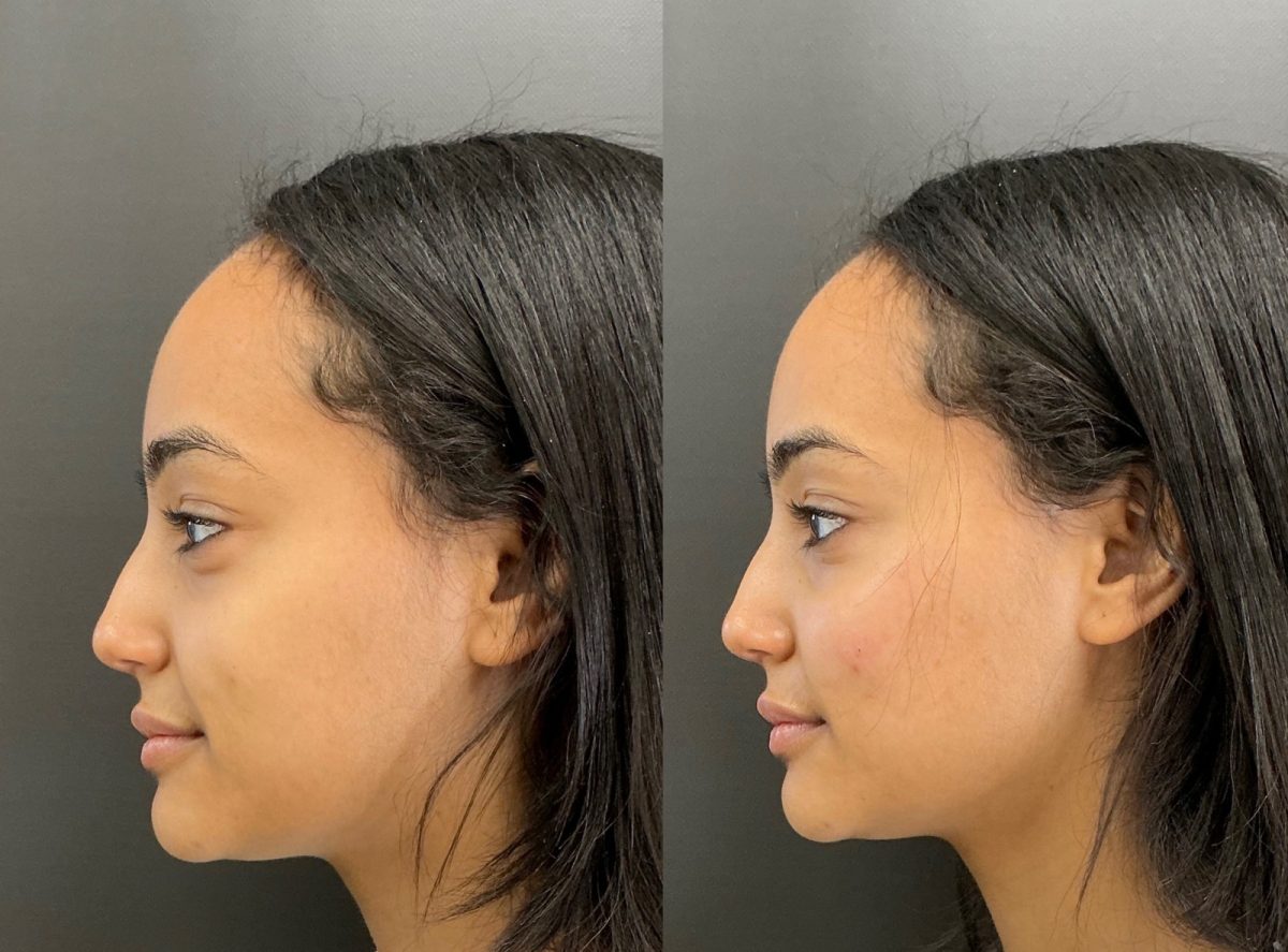 Lips & Chin Filler: before and after, Dermal Filler at Chin Up Aesthetics