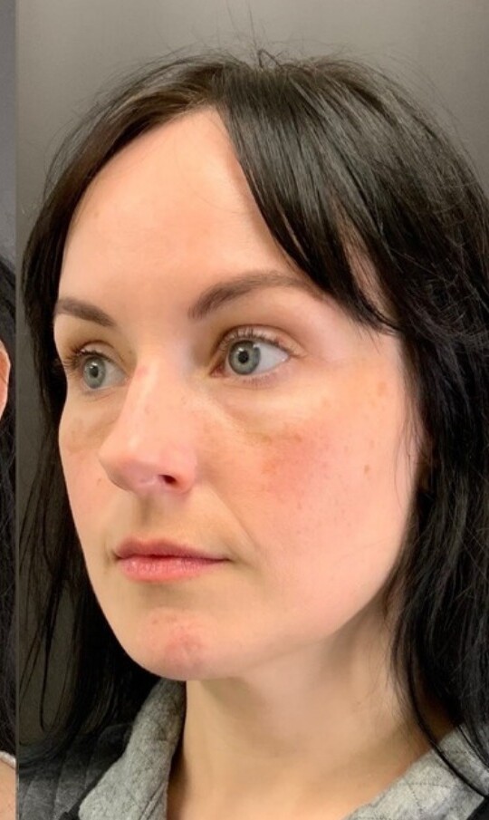Midface: after at Chin Up Aesthetics